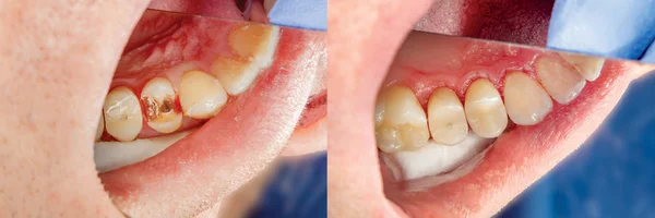 Primer Plano Los Dientes Humanos Durante Restauración Del Relleno Concepto — Foto de Stock