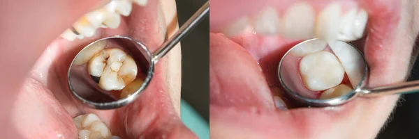 Primer Plano Los Dientes Humanos Durante Restauración Del Relleno Concepto — Foto de Stock