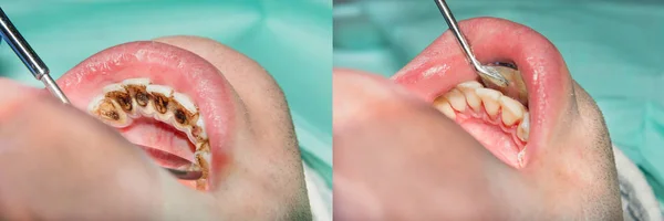 Hastanın Taş Plak Dental Plak Profesyonel Ağız Hijyeni Diş Hekimliği — Stok fotoğraf