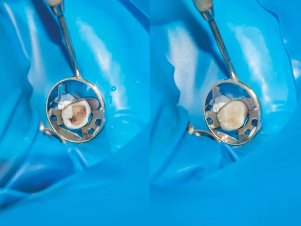 Close Human Tooth Treatment Restoration — Stock Photo, Image