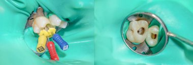 Fotoğraf endodontik tedavi alt azı kalıcı diş Endodontik dosyasıyla molar diş kanallar ile apex arama, diş cofferdam tarafından bağlı kelepçe ile