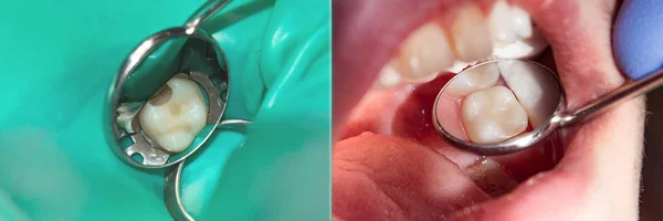 Restauração Dente Close Conceito Tratamento Estético Enchimento Dentário — Fotografia de Stock