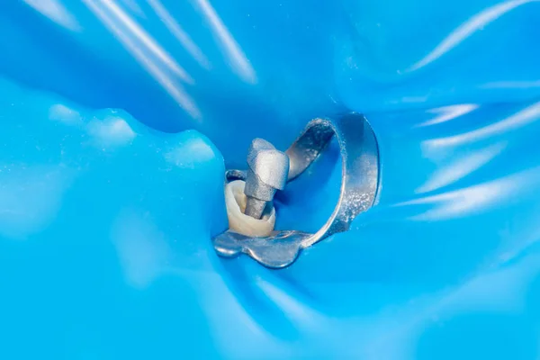 Human Tooth Close Treatment Prosthetics Metal Ceramic Crowns Concept Prosthetic — Stock Photo, Image