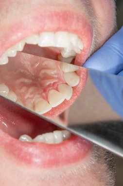 Diş yakın çekim restorasyonu. Estetik tedavi ve Diş dolgu kavramı