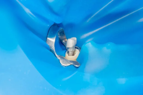 Dental Pin Close Preparation Tooth Formulation Ceramic Crown Concept Prosthetics — Stock Photo, Image