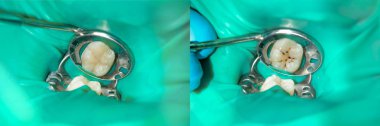 bir insan çürük carious diş tedavi aşamasında bir diş kliniğinde yakın çekim. Kauçuk baraj sistemiyle lateks eşarp ve metal klipleri, photopolymeric kompozit dolgular üretiminde kullanımı