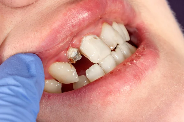 Γκρο Πλαν Ανθρώπινο Δόντι Κατά Διάρκεια Της Θεραπείας Και Προσθετική — Φωτογραφία Αρχείου