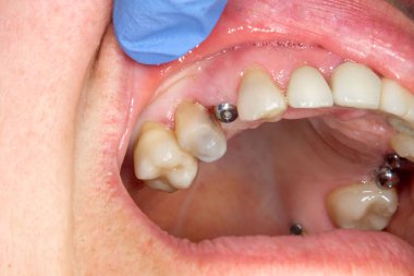 Yakın çekim implant diş otu hastada tedavi sırasında diş kliniği. Cerrahi Estetik Diş Hekimliği kavramı