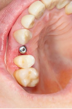 Yakın çekim implant diş otu hastada tedavi sırasında diş kliniği. Cerrahi Estetik Diş Hekimliği kavramı