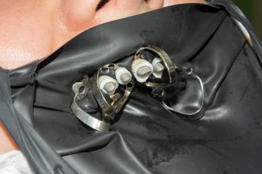 Fiberglas pimleri ile endodontik tedavi sonrasında restorasyon diş. Ortopedik estetik diş hekimliği kavramı