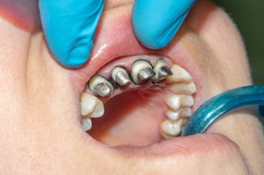 çürük kökleri ile seramik kron diş diş restorasyonu. Döküm diş hekimliği mesajları