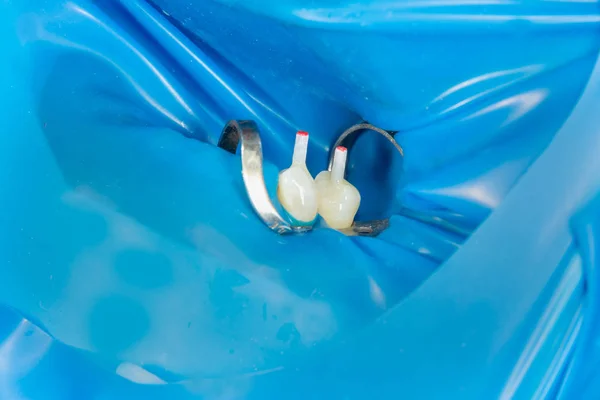 Restoration Teeth Endodontic Treatment Fiberglass Pins Concept Aesthetic Orthopedic Dentistry — Stock Photo, Image