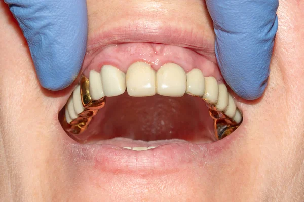 Restauration Dentaire Des Racines Pourries Des Dents Avec Des Couronnes — Photo