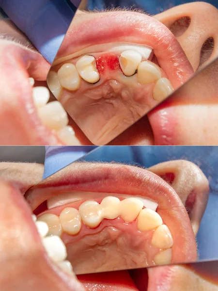 Installation Fiberglass Bridge Teeth Using Photopolymer Restoration Material Close Concept — Stock Photo, Image