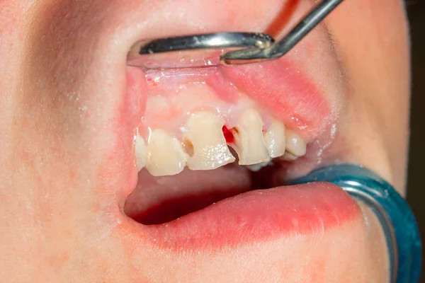Dois Dentes Laterais Mastigatórios Mandíbula Superior Após Tratamento Cárie Restauração — Fotografia de Stock