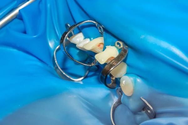 两个咀嚼侧牙的上颌骨治疗龋齿后 用橡胶坝系统感光树脂充填材料修复咀嚼面 — 图库照片