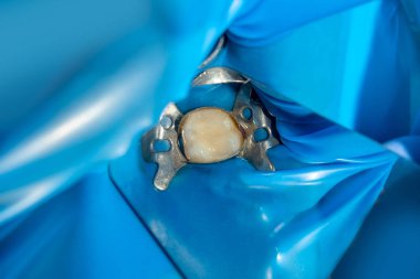 iki çürük tedaviden sonra üst çene yan dişlerin çiğneme. Dolgu lastik baraj sistemiyle Fotopolimer çiğneme yüzeyle restorasyonu