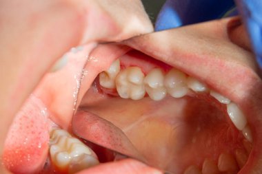 iki çürük tedaviden sonra üst çene yan dişlerin çiğneme. Dolgu lastik baraj sistemiyle Fotopolimer çiğneme yüzeyle restorasyonu
