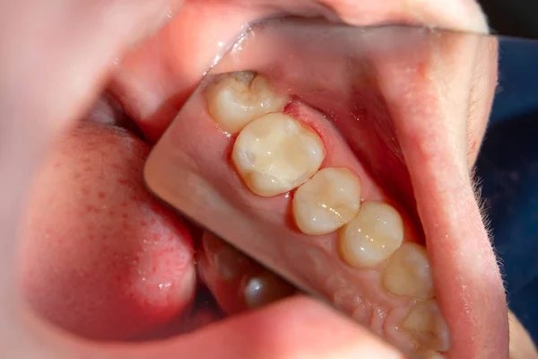 Iki Çürük Tedaviden Sonra Üst Çene Yan Dişlerin Çiğneme Dolgu — Stok fotoğraf