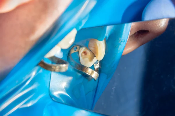 两个咀嚼侧牙的上颌骨治疗龋齿后 用橡胶坝系统感光树脂充填材料修复咀嚼面 — 图库照片