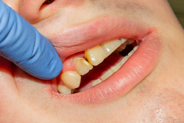 Dois Dentes Laterais Mastigatórios Mandíbula Superior Após Tratamento Cárie Restauração — Fotografia de Stock