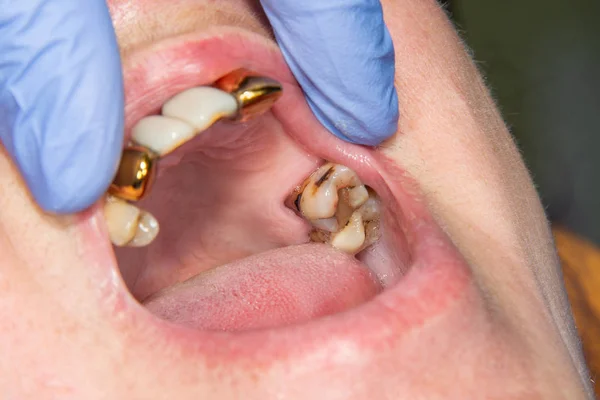 Patient with bad metal dental crowns close-up. The concept of treatment and restoration of aesthetics in  dental clinic