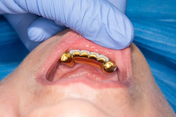 Patient Bad Metal Dental Crowns Close Concept Treatment Restoration Aesthetics — Stock Photo, Image