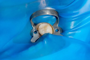 Diş bakımı. Haham kullanarak diş kompozit fotopolimer materyaliyle dolduruluyor. Diş sağlığı kliniğinde diş tedavisi kavramı