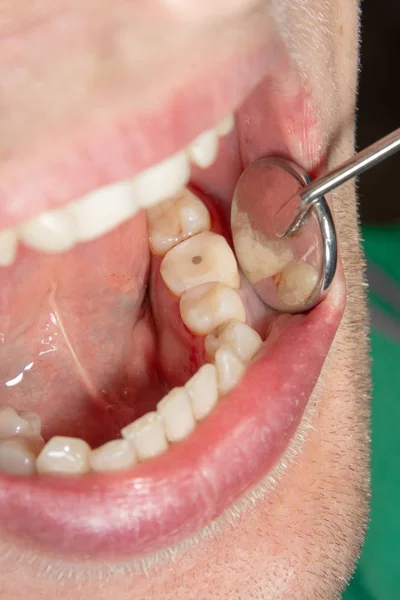 Caries Dental Relleno Con Material Fotopolímero Compuesto Dental Utilizando Rabbders — Foto de Stock