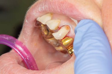 iki çürük tedaviden sonra üst çene yan dişlerin çiğneme. Dolgu lastik baraj sistemiyle Fotopolimer çiğneme yüzeyle restorasyonu