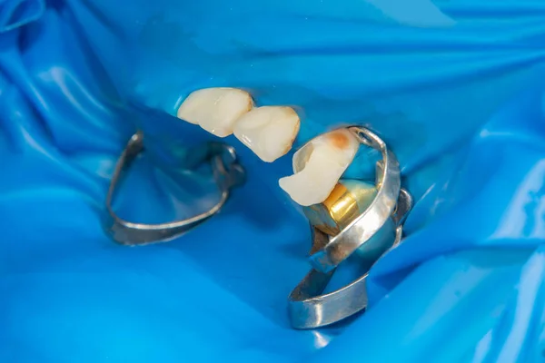 Два Жувальні Зуби Стороні Верхньої Щелепи Після Лікування Карієсу Реставрація — стокове фото