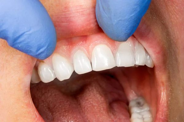 Deux Dents Latérales Mâcher Mâchoire Supérieure Après Traitement Des Caries — Photo