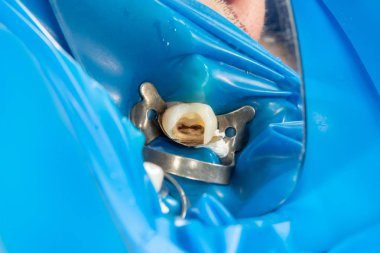 endodontik tedavi diş yakın çekim. Onların dolum ve diş köklerinin temizlik. Diş kliniğinde modern teknoloji kavramı