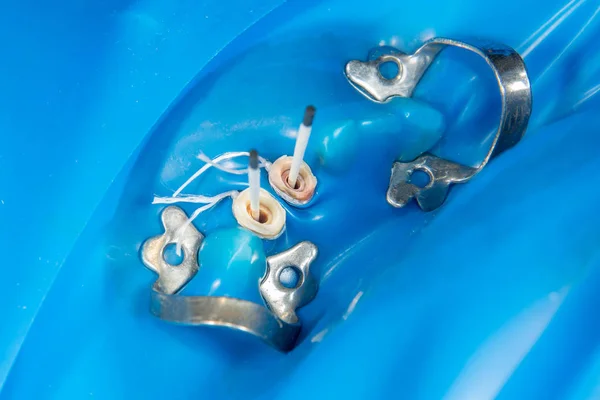 Dental Restoration Rotten Roots Teeth Ceramic Crowns Cast Posts Dentistry — Stock Photo, Image