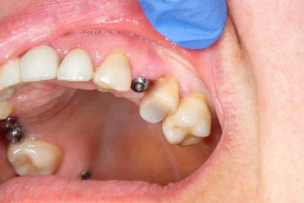 Γκρο Πλαν Οδοντικό Εμφύτευμα Wort Ασθενής Ένα Οδοντιατρείο Κατά Διάρκεια — Φωτογραφία Αρχείου