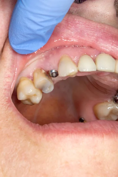 Paciente Com Implante Dentário Perto Uma Clínica Odontológica Durante Tratamento — Fotografia de Stock