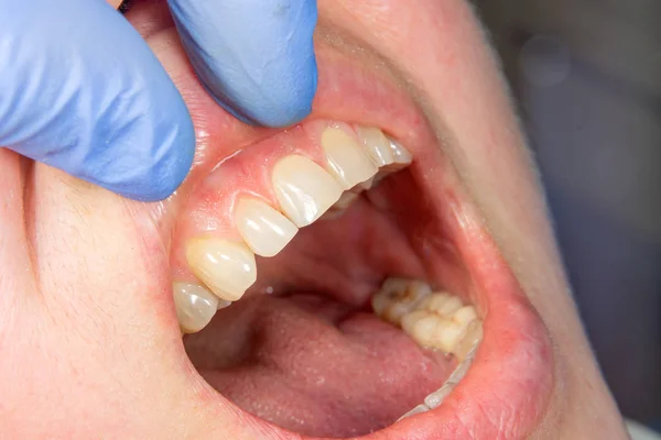 Caries Dental Relleno Con Material Fotopolímero Compuesto Dental Utilizando Rabbders —  Fotos de Stock