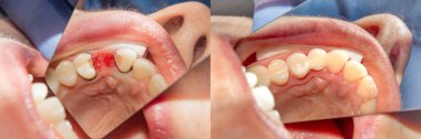 doldurma ve Diş kaybının yapışkanlı kompozit malzeme yakın çekim ile restorasyonu. Kavram diş hekimliği işlemden önce ve sonra