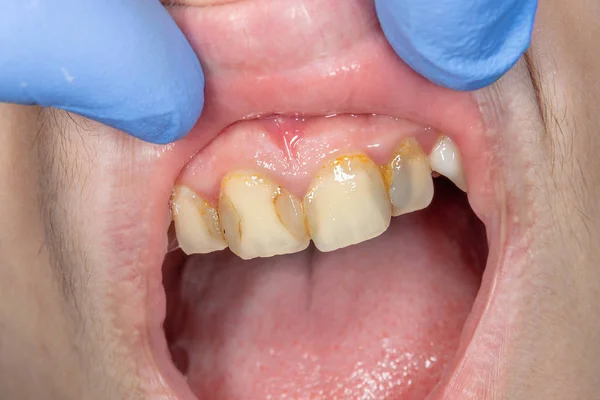 歯科医院での歯科治療 腐った齲蝕歯クローズ アップ マクロ 歯内療法根管の治療 — ストック写真