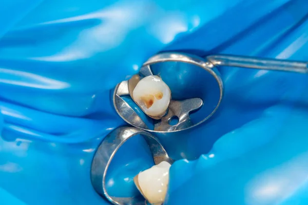 歯のケアだ ラバーを使用して歯科複合光高分子材料で充填します 歯科診療所における歯科治療の概念 — ストック写真