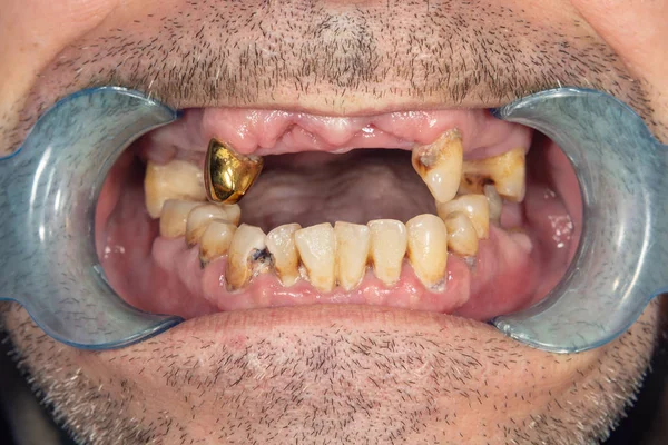 Dents Pourries Caries Plaque Gros Plan Chez Patient Gravement Malade — Photo