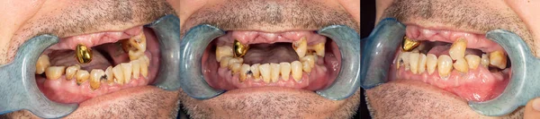 腐った歯 Asocially 病気の患者で齲蝕とプラークのクローズ アップ 貧しい人々 の衛生問題の概念 — ストック写真