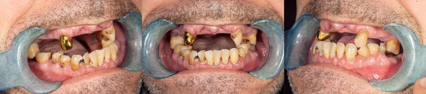 Dientes Podridos Caries Placa Cerca Paciente Socialmente Enfermo Concepto Higiene — Foto de Stock