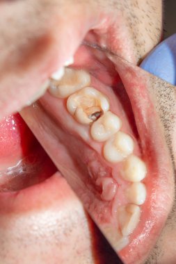 Diş bakımı. Haham kullanarak diş kompozit fotopolimer materyaliyle dolduruluyor. Diş sağlığı kliniğinde diş tedavisi kavramı