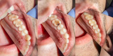 Diş bakımı. Haham kullanarak diş kompozit fotopolimer materyaliyle dolduruluyor. Diş sağlığı kliniğinde diş tedavisi kavramı