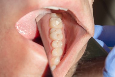 Diş bakımı. Haham kullanarak diş kompozit fotopolimer materyaliyle dolduruluyor. Diş sağlığı kliniğinde diş tedavisi kavramı