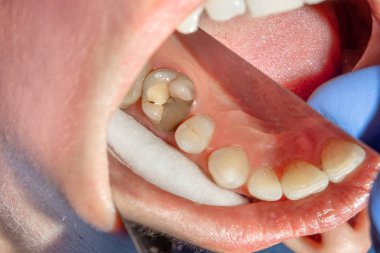 iki çürük tedaviden sonra üst çene yan dişlerin çiğneme. Dolgu lastik baraj sistemiyle Fotopolimer çiğneme yüzeyle restorasyonu