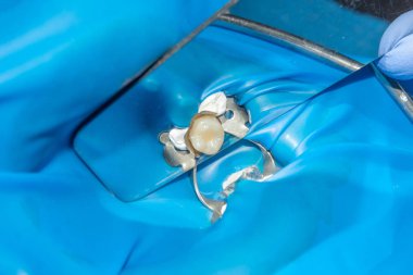 iki çürük tedaviden sonra üst çene yan dişlerin çiğneme. Dolgu lastik baraj sistemiyle Fotopolimer çiğneme yüzeyle restorasyonu