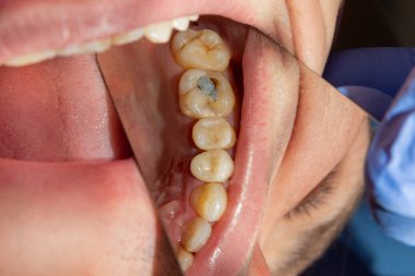 iki çürük tedaviden sonra üst çene yan dişlerin çiğneme. Dolgu lastik baraj sistemiyle Fotopolimer çiğneme yüzeyle restorasyonu