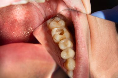 iki çürük tedaviden sonra üst çene yan dişlerin çiğneme. Dolgu lastik baraj sistemiyle Fotopolimer çiğneme yüzeyle restorasyonu